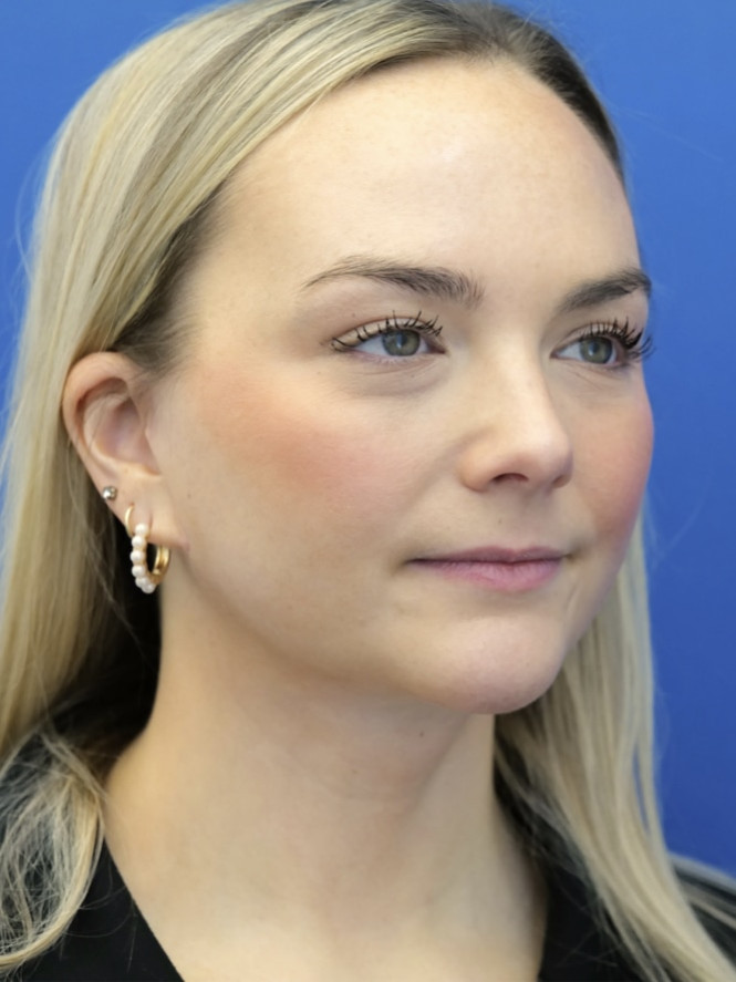 Case 7154: after Natural Result