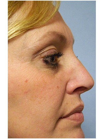 Mild Dorsal Hump & Droopy Tip2* — After