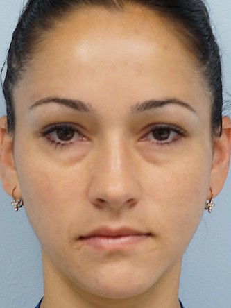Restylane Silk to Tear Trough – Under Eye* — Before