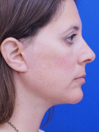 Facelift, Eyelid Lift, and Chin Liposuction* — After
