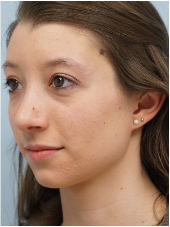 Prominent Nose Closed Rhinoplasty* — After
