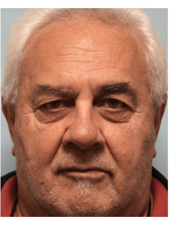 Visual Field Deficit – Eyelid Excess Skin2* — Before