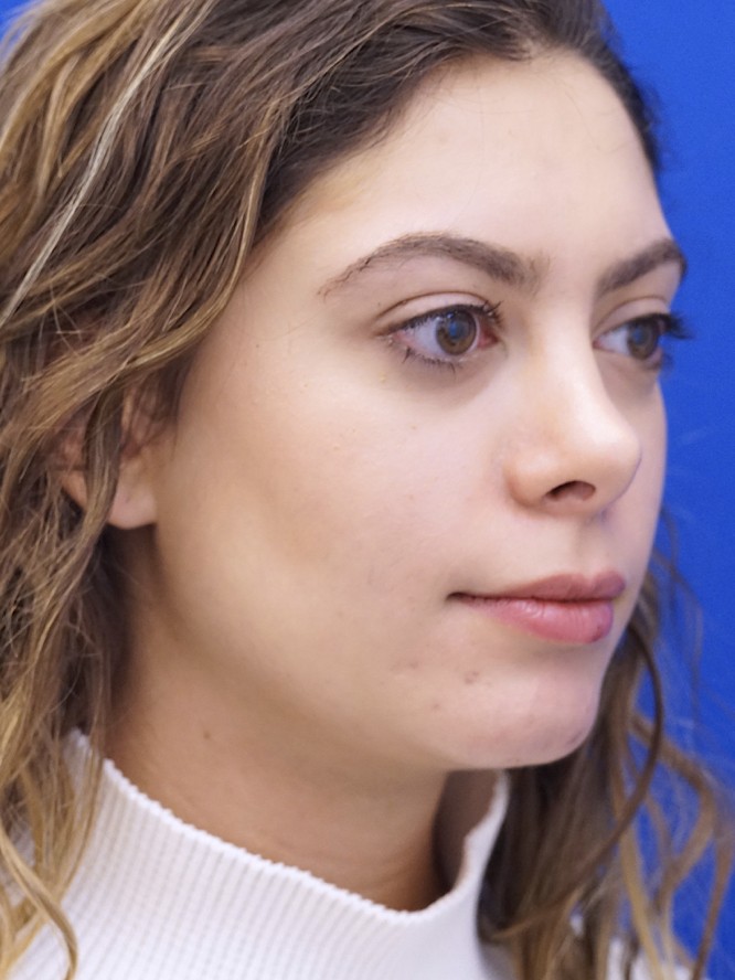 Hump Reduction and Chin Projection — After