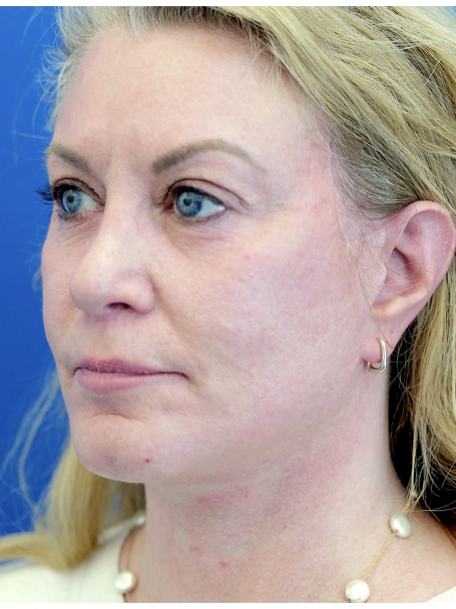 Lower Facial and Neck Fullness — After