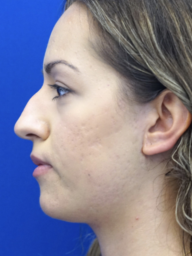 Dorsal Hump Removal — Before