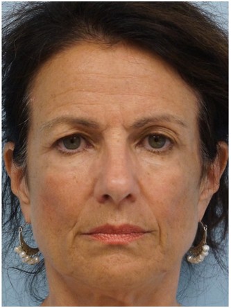 Upper Eyelid Skin Excess1* — Before