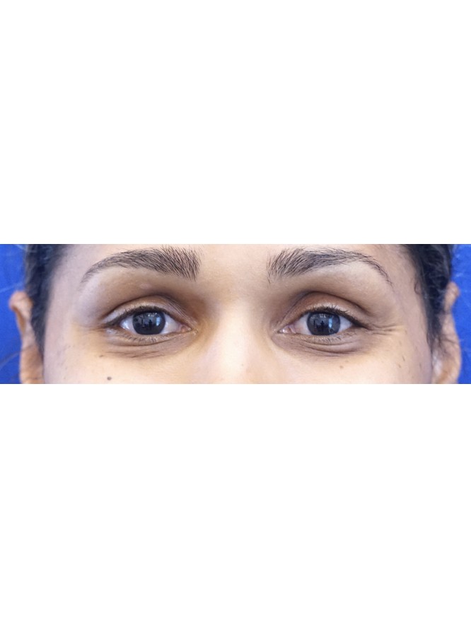 Lower Eyelid Dark Skin Tone — Before