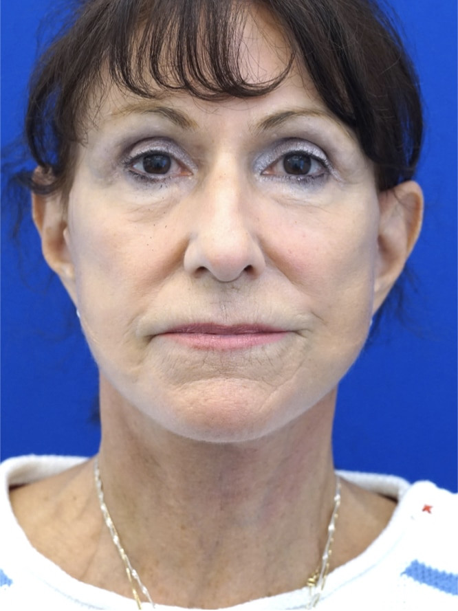 Revision Forehead and Facelift — After