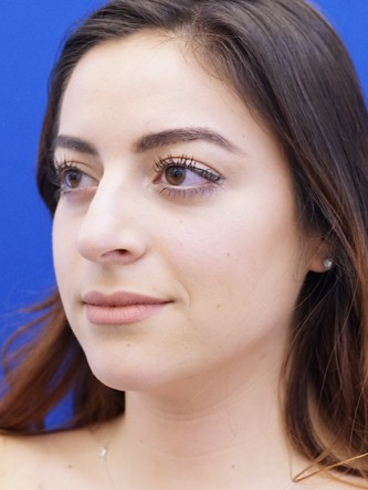 Finesse Nasal Aesthetics* — Before