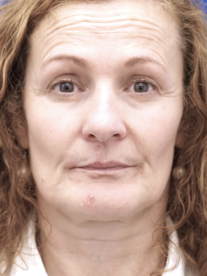 Perioral Volume Loss — Before