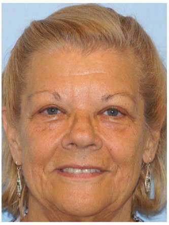 Upper Eyelid Droop and Skin Excess* — After