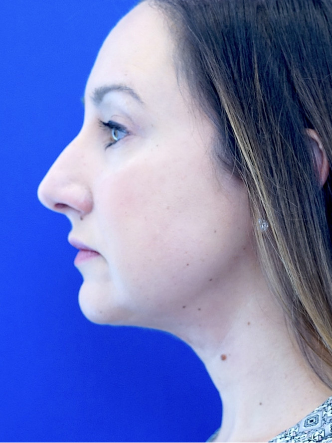 Chin and Neck Definition — After