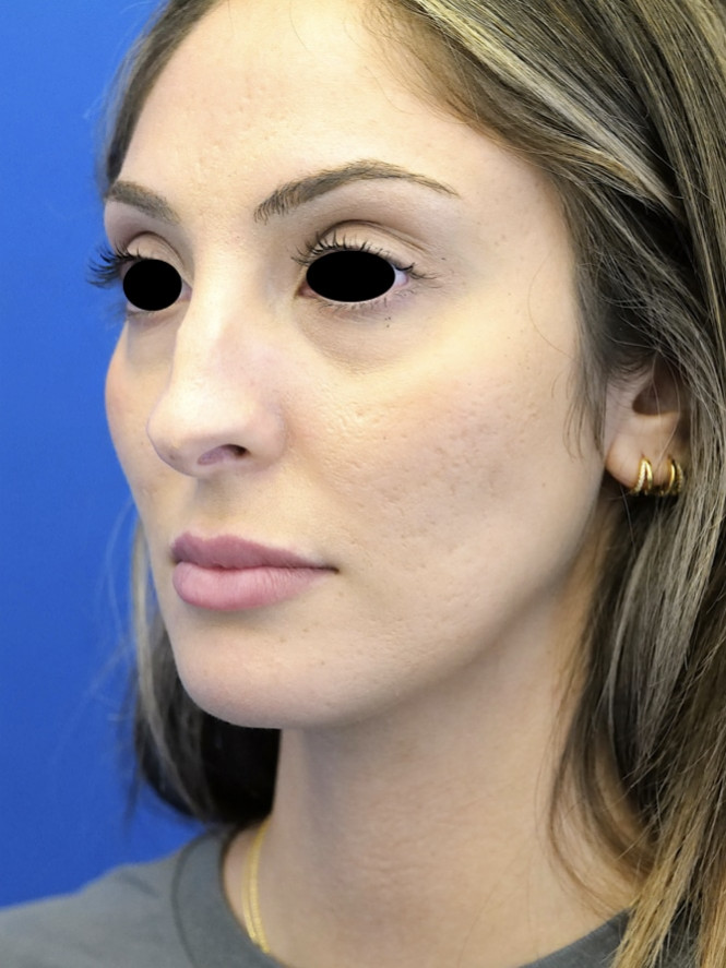 Beautiful Result — Before