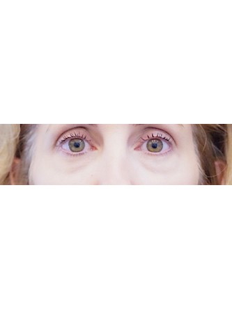 Filler for Under Eye* — Before