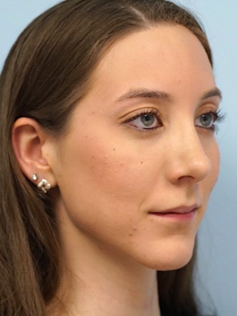 Nasal Hump Endonasal Rhinoplasty* — After