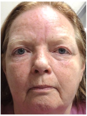 Visual Field Deficit – Eyelid Excess Skin4* — After