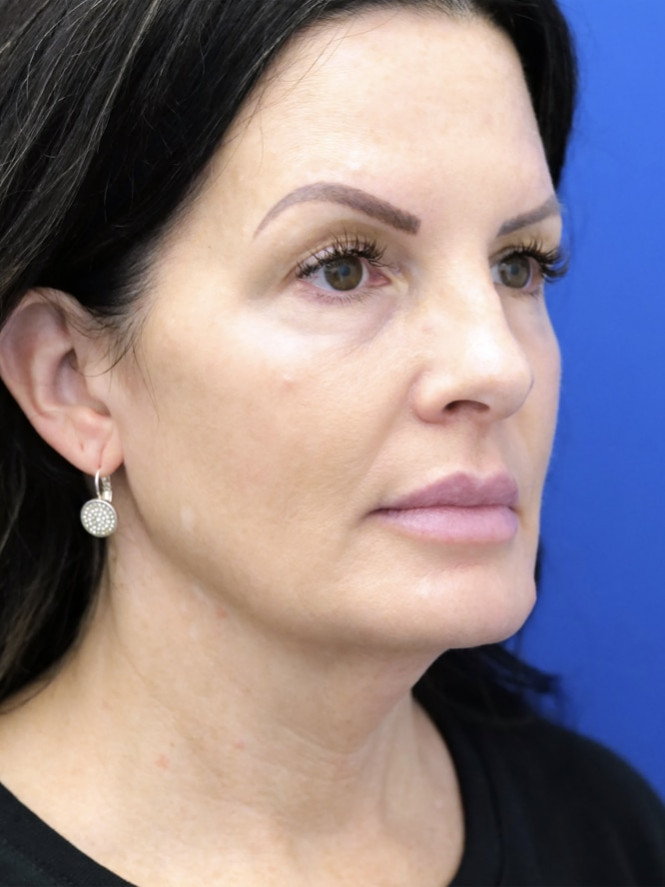 Deep Plane Cheek and Facelift — Before