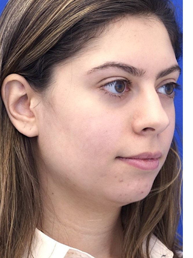 Hump Reduction and Chin Projection — Before
