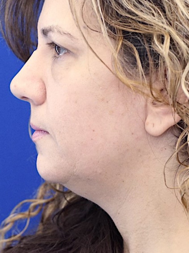 Deep Plane Face Lifting — Before