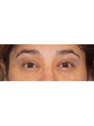 Right Ptosis Repair* — After