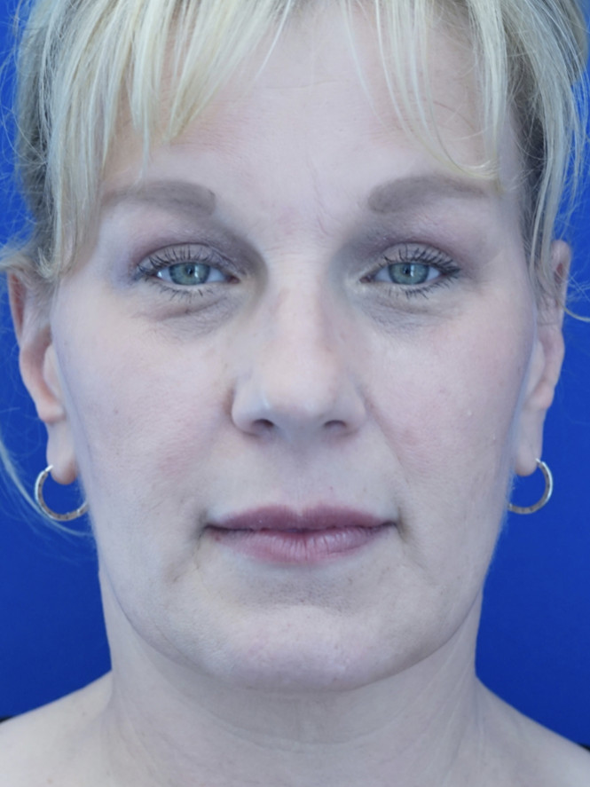 Upper Eyelid Rejuvenation — After