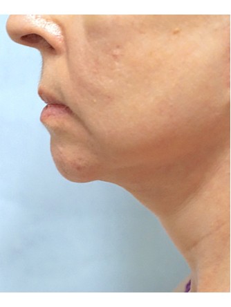 Neck Lift* — After