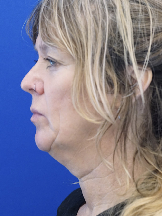 Case 5704: before Fantastic Facial Profile
