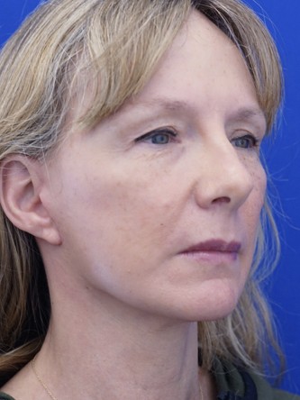 Upper Eyelid Lift* — Before