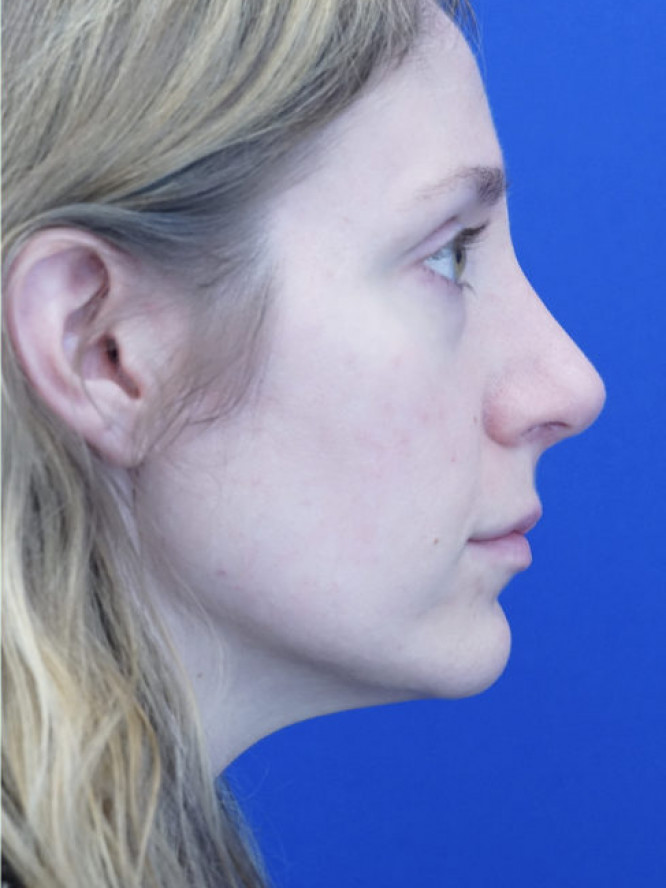 Nasal Profile Finesse — After