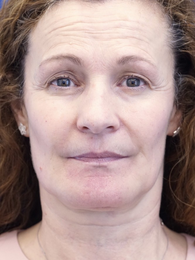 Perioral Volume Loss — After