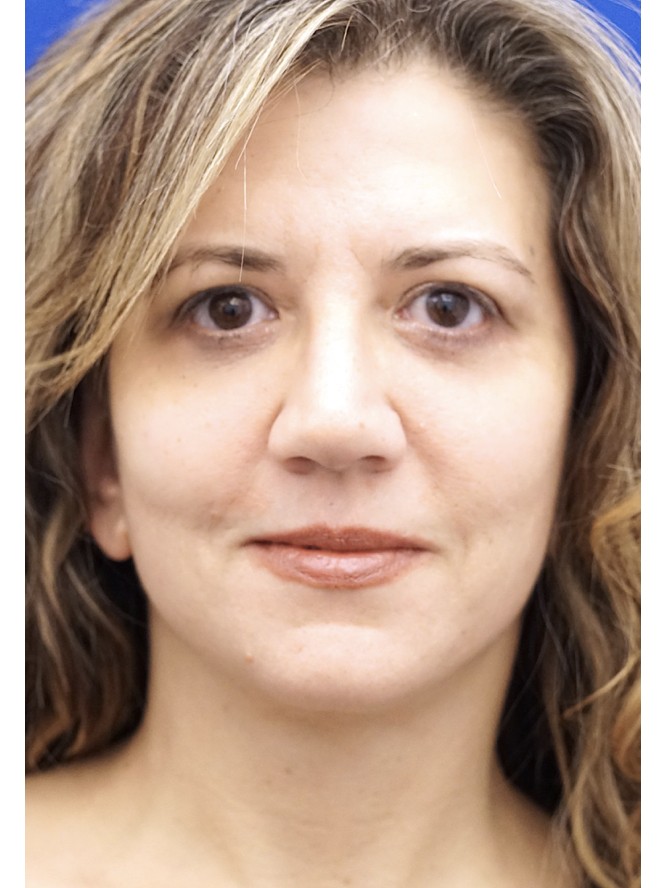 Deep Plane Face Lifting — After