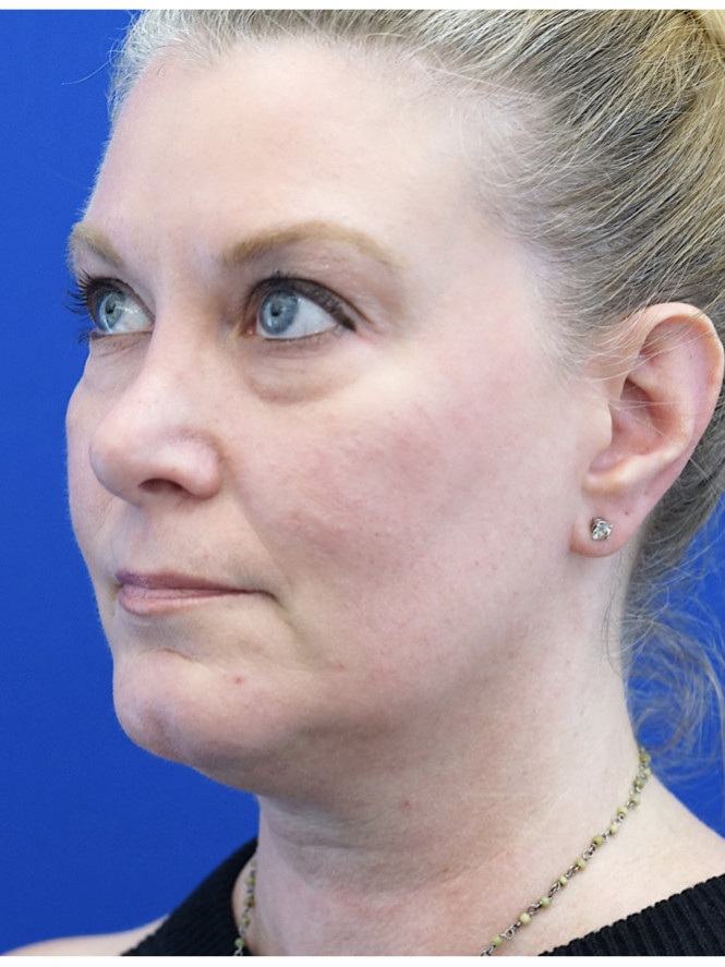 Lower Facial and Neck Fullness — Before