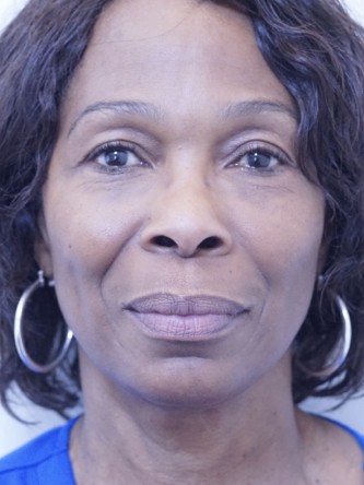 Tear Trough Under Eye Enhancement — After