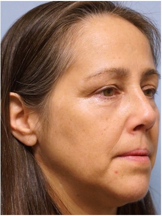Nasal Septal Perforation2* — After