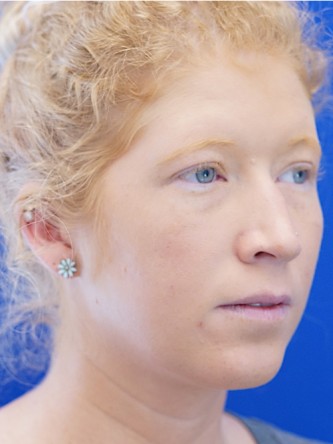 Liquid Rhinoplasty* — Before