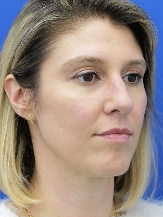 Case 6903: before Dorsal Hump and Finesse Tip