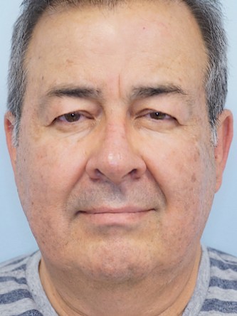 Blepharoplasty Ptosis Repair* — Before