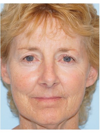 Upper Eyelid Droop2* — After