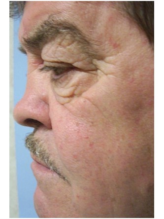 Saddle Nose – Repair Using Ear Cartilage* — Before