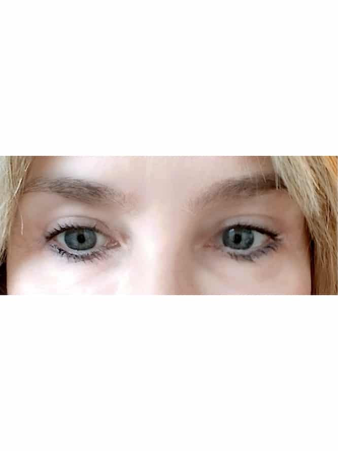 Cosmetic Upper Eyelid Surgery — After
