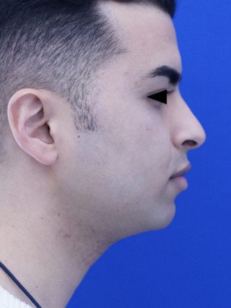 Case 2323: before Vertical Lengthening Chin*