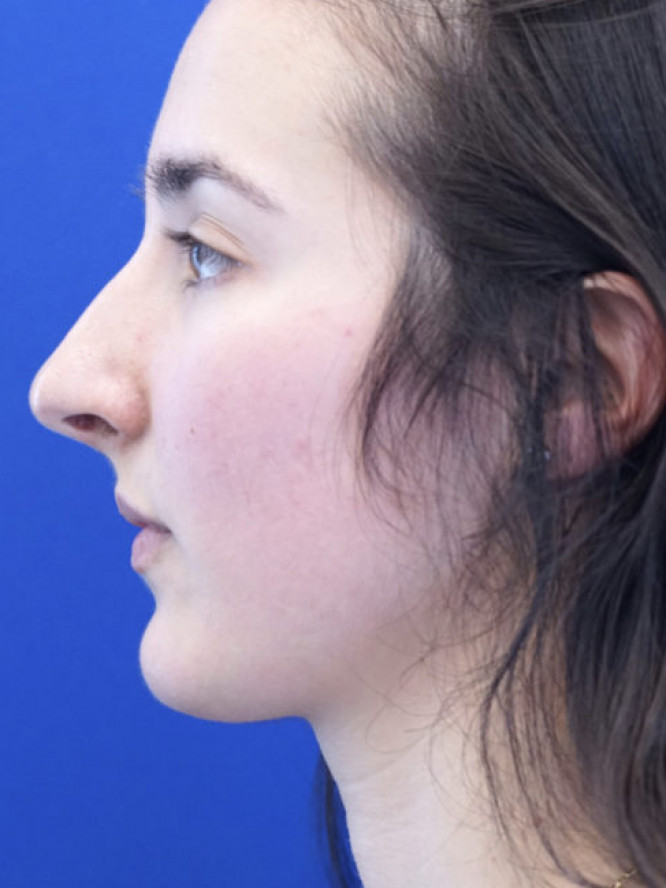 Endonasal Finesse Rhinoplasty — Before