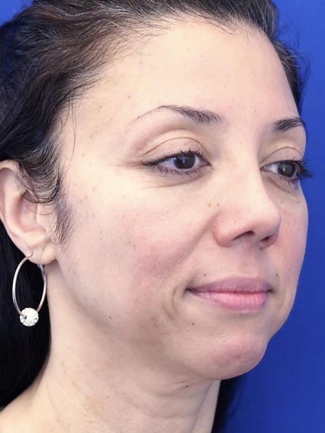 Natural Result — After