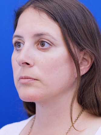 Facelift, Eyelid Lift, and Chin Liposuction* — After