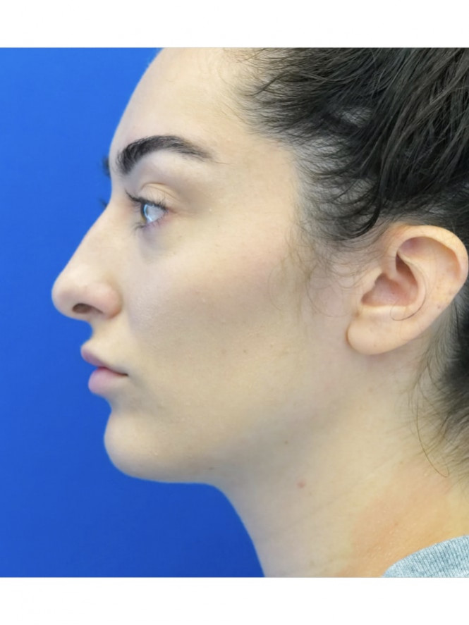 Ideal Nasal Profile — Before