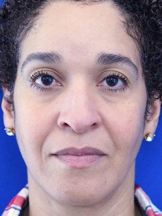 Ethnic Rhinoplasty* — Before