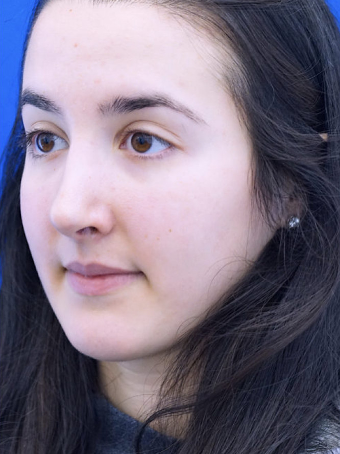 Endonasal Finesse Rhinoplasty — After