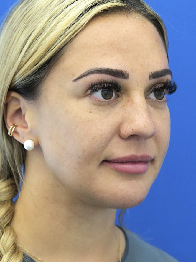Lower Facial Rejuvenation — After