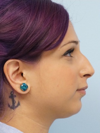Juvederm Upper and Lower Lip Fillers* — Before