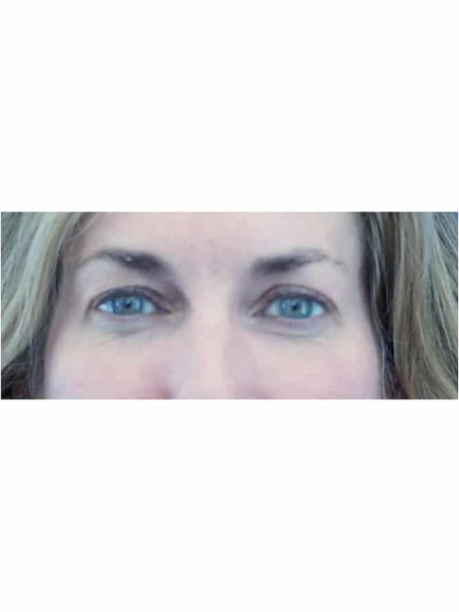 Brightening Eyes — Before